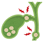 Gallbladder Stone