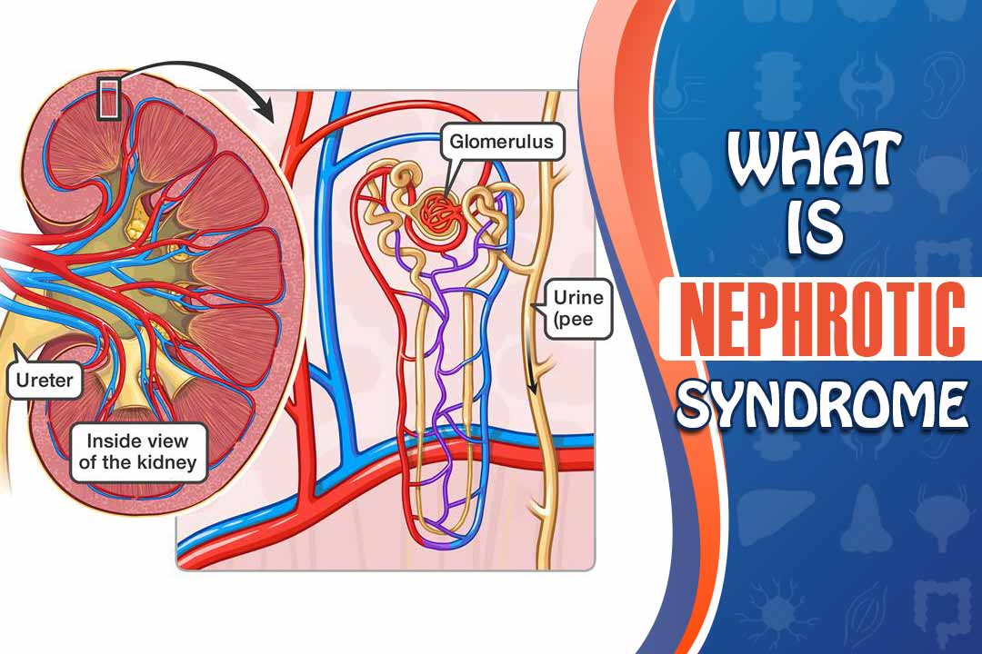 Signs And Symptoms Of Nephrotic Syndrome