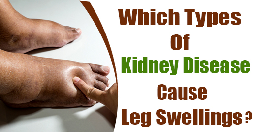 Kidney Failure Leg Swelling Leg Swelling Kidney Disease Karma 